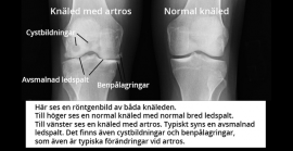 Bild 2. Röntgenbild av knäled med artros och normal